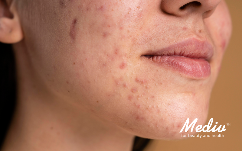 3步護理皮膚 去除面部粉刺 