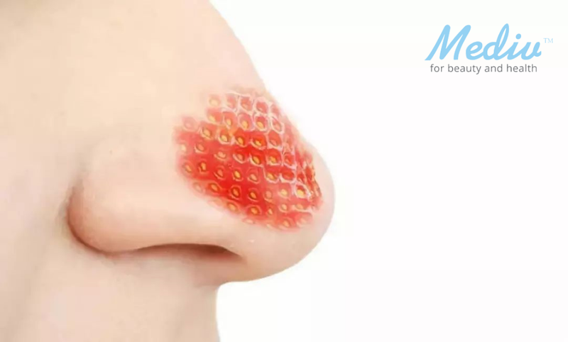 【清黑頭攻略】Aqua Peel Up 幫你高效清黑頭