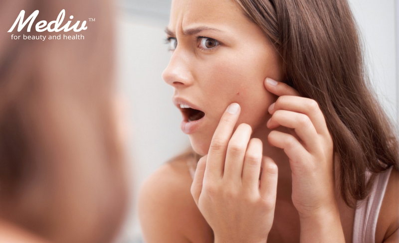 【去暗瘡秘訣】4個必知快速去暗瘡方法